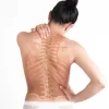 scoliosis